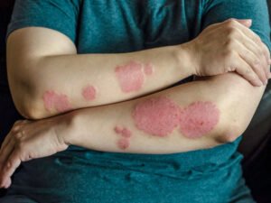 Read more about the article Ayurvedic treatment for Psoriasis