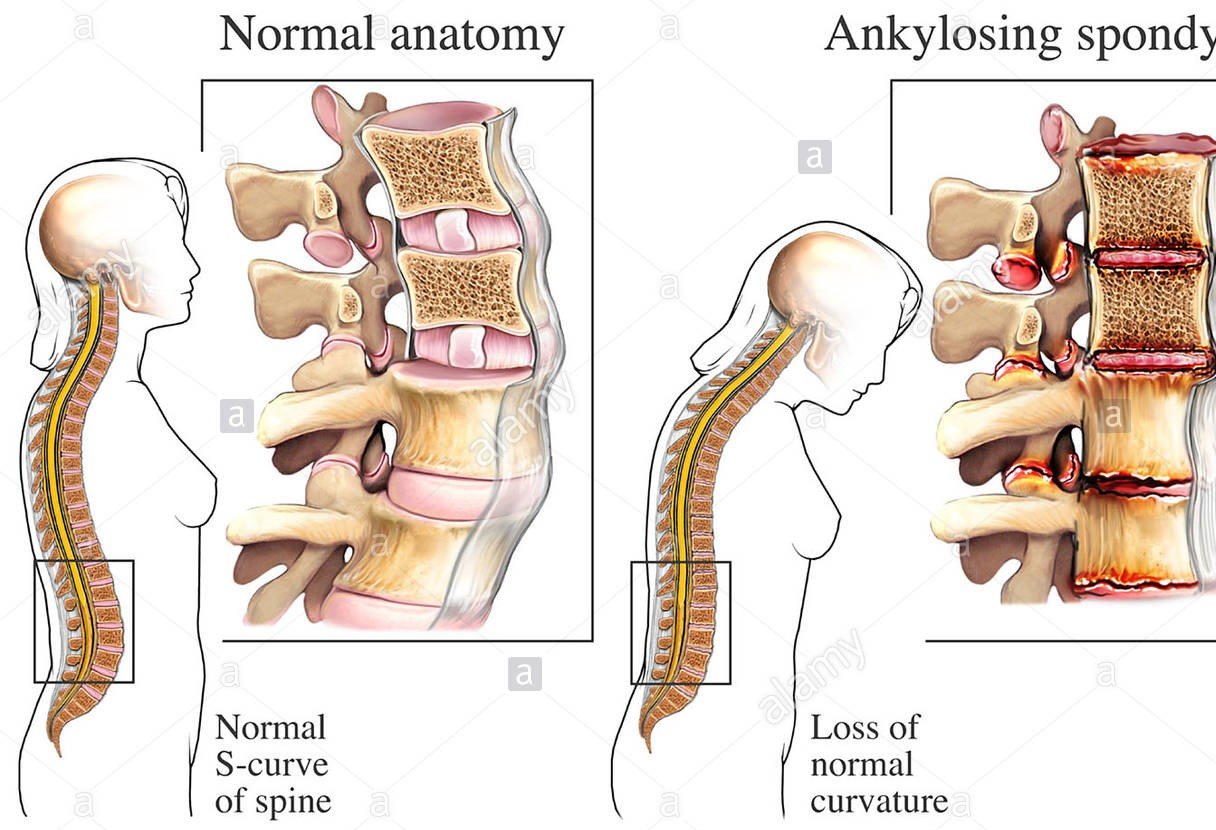 Ayurvedic Treatment  for Ankylosing Spondylitis: Diet, Medicines and Therapies