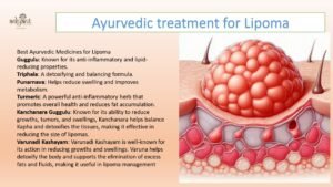 Read more about the article Lipoma Treatment in Ayurveda