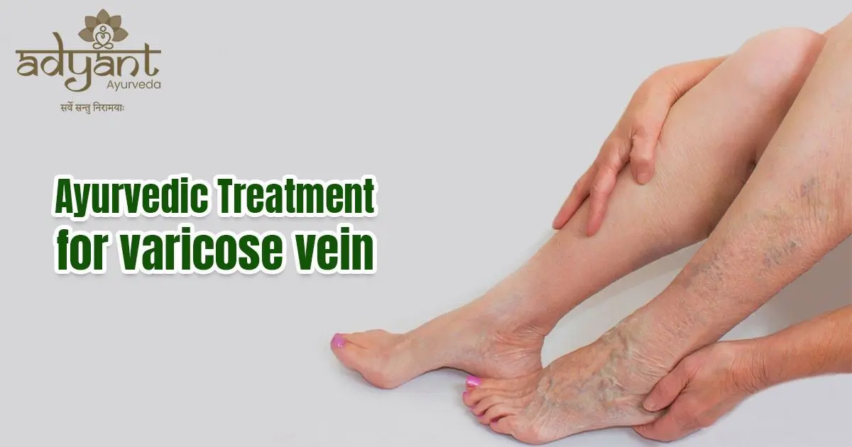 Ayurvedic Treatment for Varicose Vein