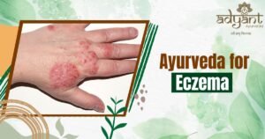 Read more about the article Ayurvedic Treatment for Eczema: Symptoms, Herbal Remedies & More