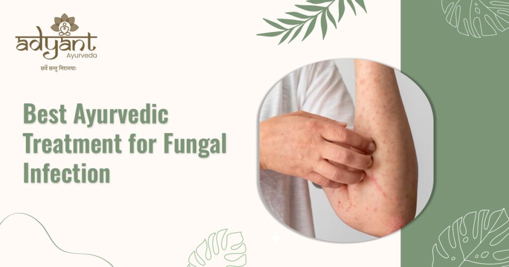 Best Ayurvedic Treatment for Fungal Infection - Adyant Ayurveda
