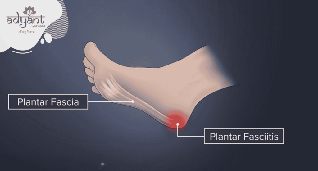 Symptoms of Plantar Fasciitis According to Ayurveda