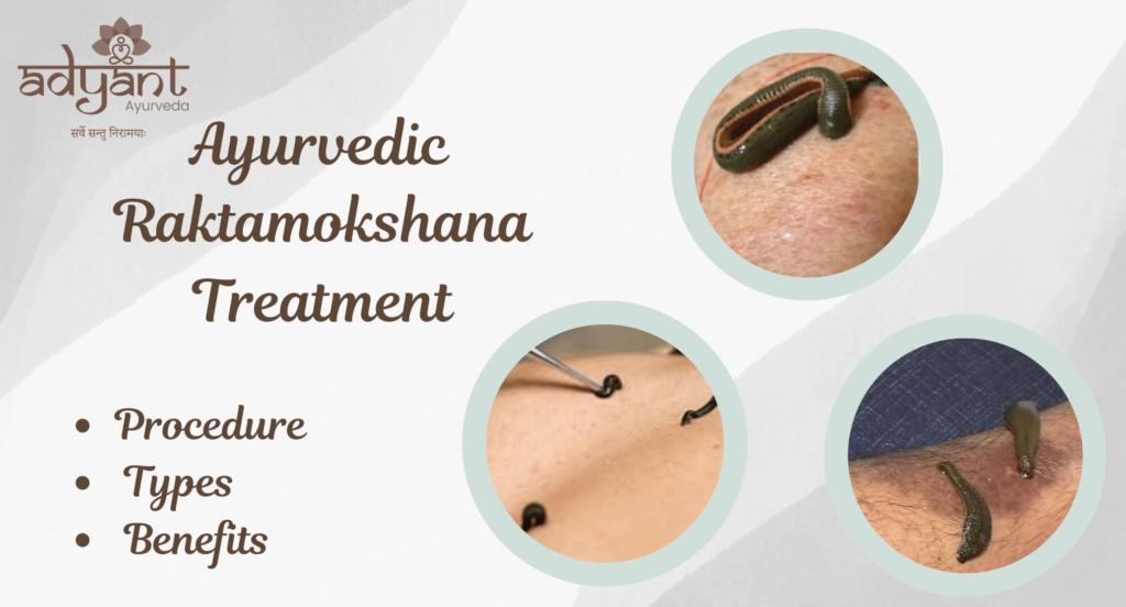 Ayurvedic Raktamokshana Treatment: Procedure, Types, Benefits & More