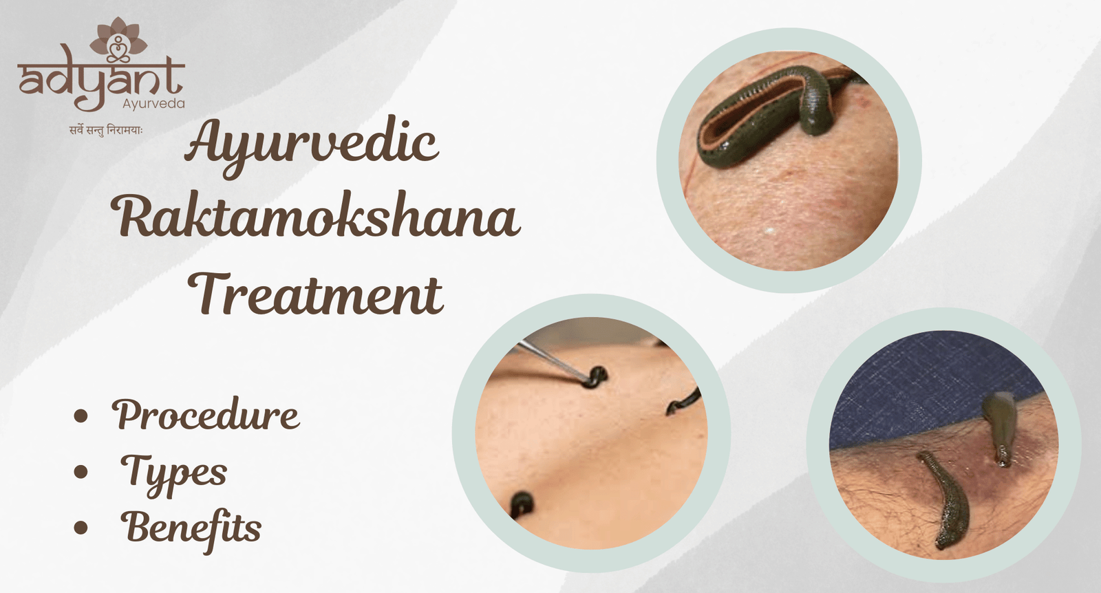 You are currently viewing Ayurvedic Raktamokshana Treatment: Procedure, Types, Benefits & More