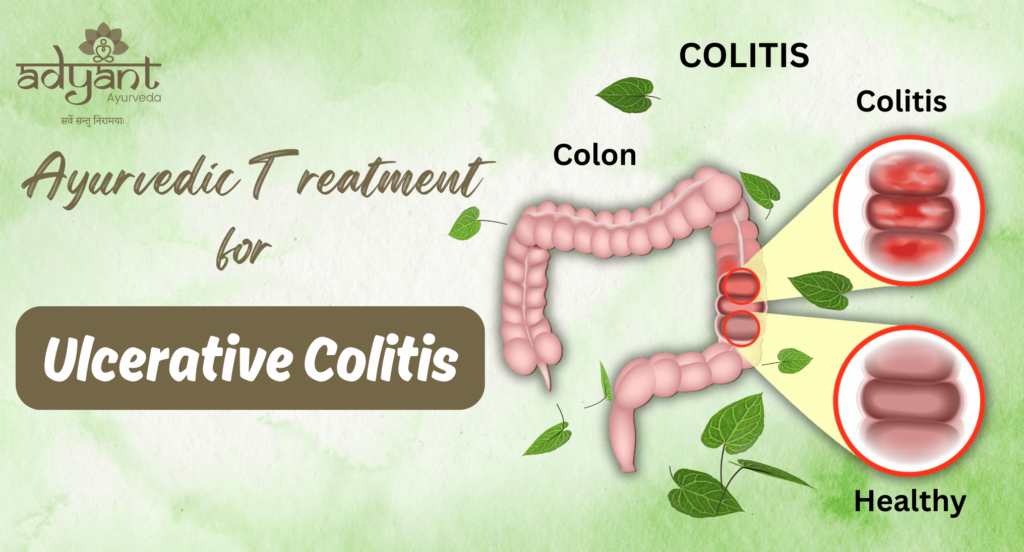 Ayurvedic Treatment for Ulcerative Colitis: Causes | Herbal Remedies | Diet | Therapies