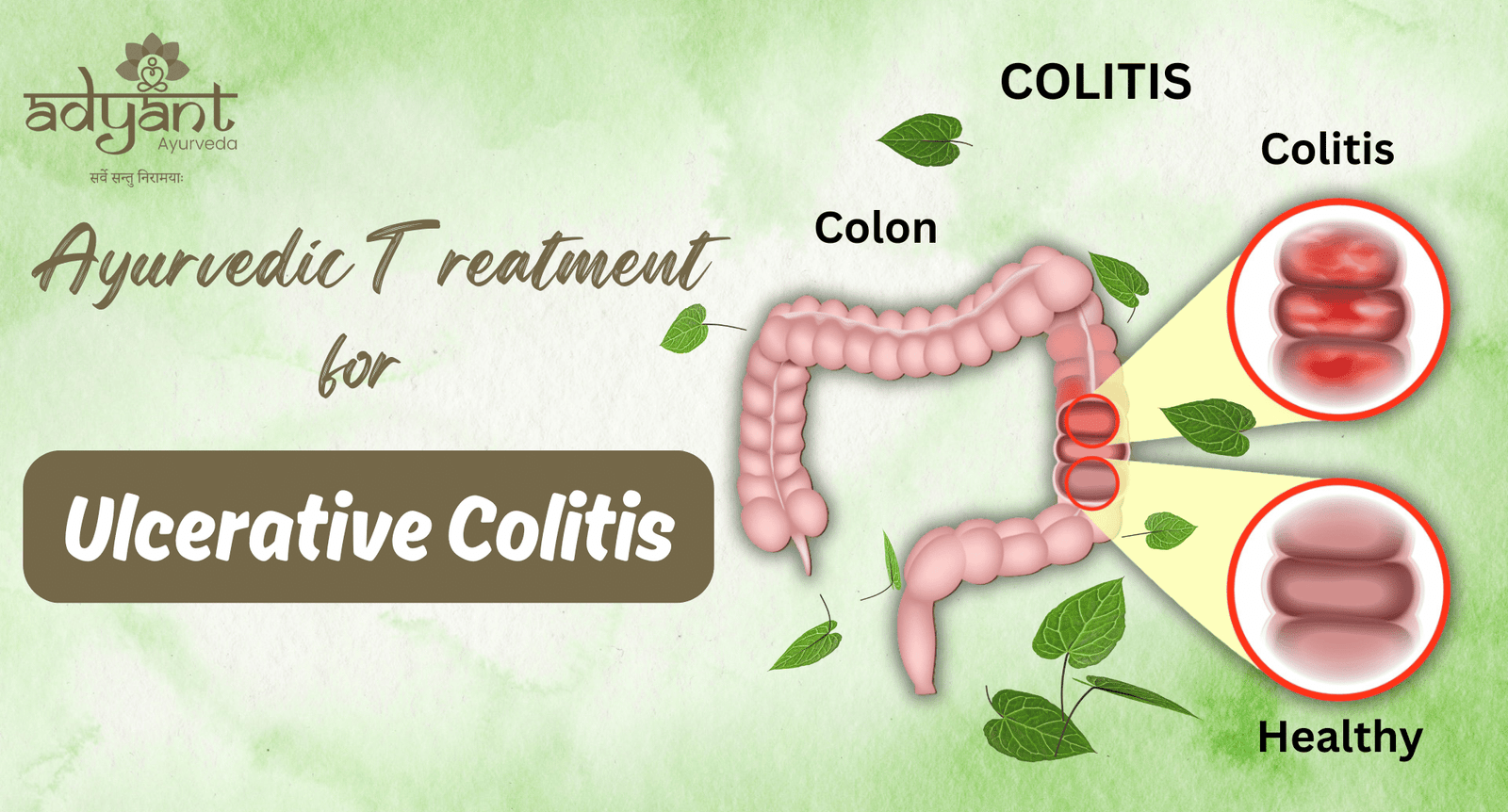 Read more about the article Ayurvedic Treatment for Ulcerative Colitis: Causes | Herbal Remedies | Diet | Therapies