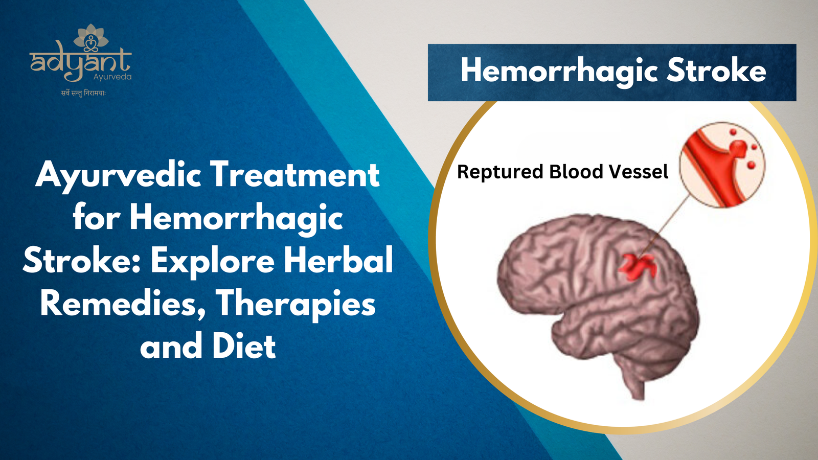 Read more about the article Ayurvedic Treatment for Hemorrhagic Stroke: Explore Herbal Remedies, Therapies and Diet