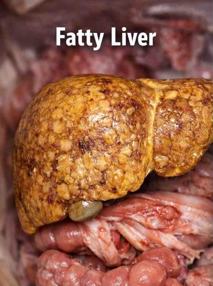 fatty liver