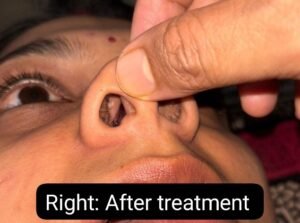 A Case Study on Management of Nasal Polyp with Kshara Karma