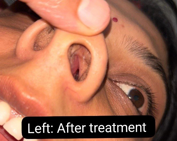 A Case Study on Management of Nasal Polyp with Kshara Karma