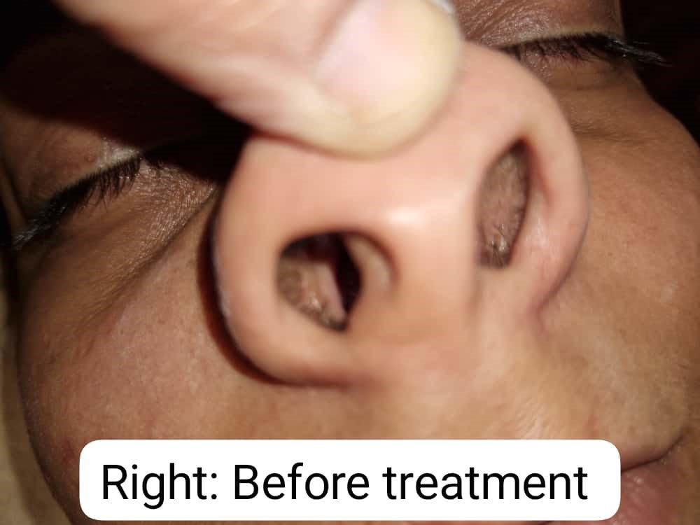 A Case Study on Management of Nasal Polyp with Kshara Karma