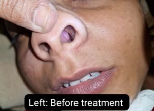 A Case Study on Management of Nasal Polyp with Kshara Karma