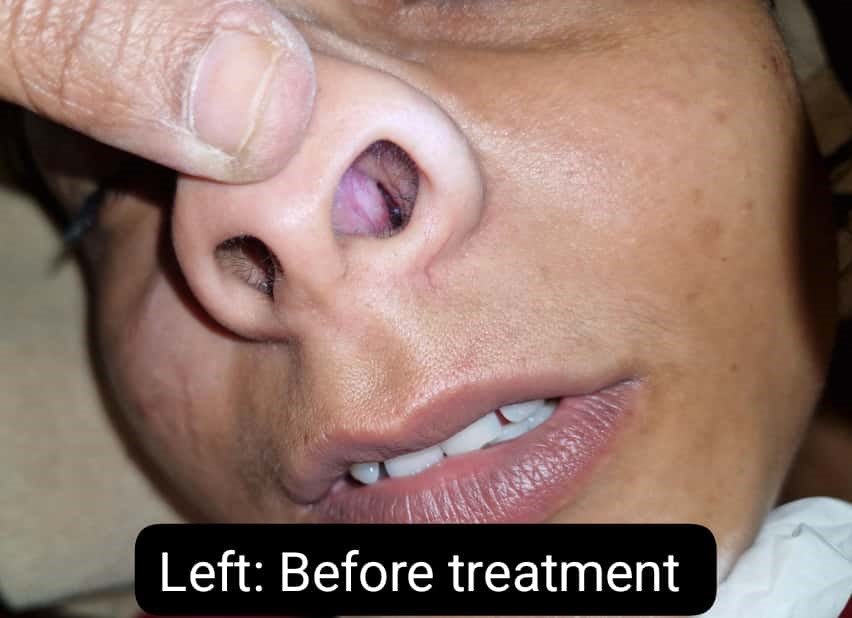 A Case Study on Management of Nasal Polyp with Kshara Karma