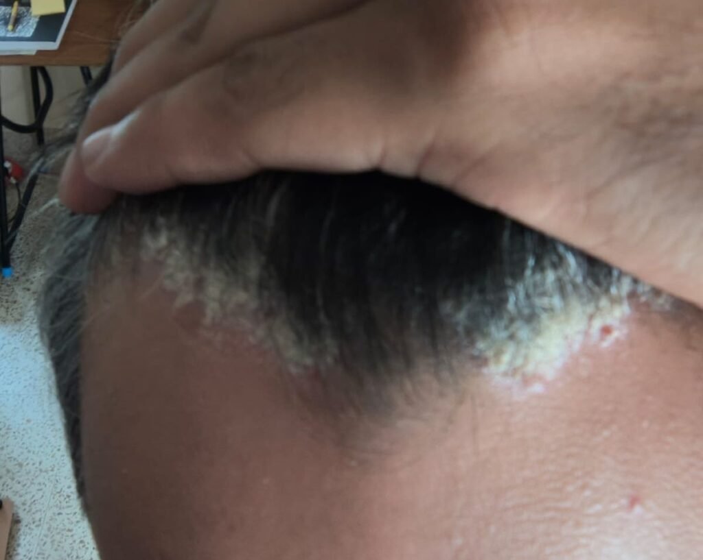 before treatment Scalp Psoriasis case study