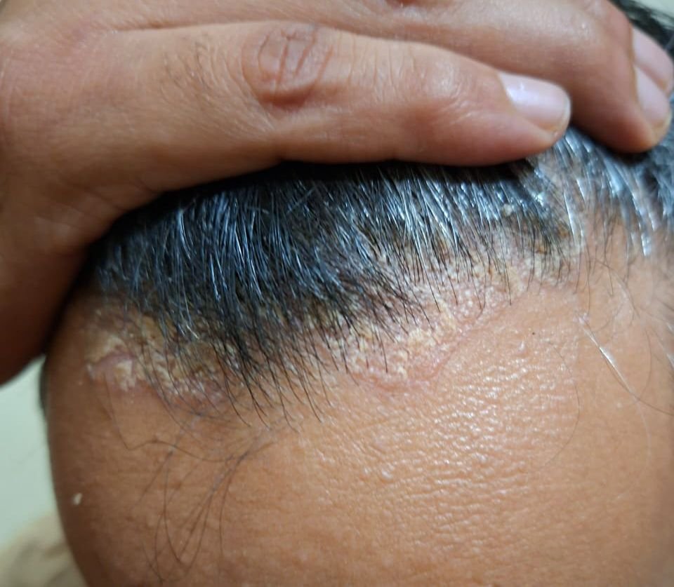 before treatment Scalp Psoriasis case study 2