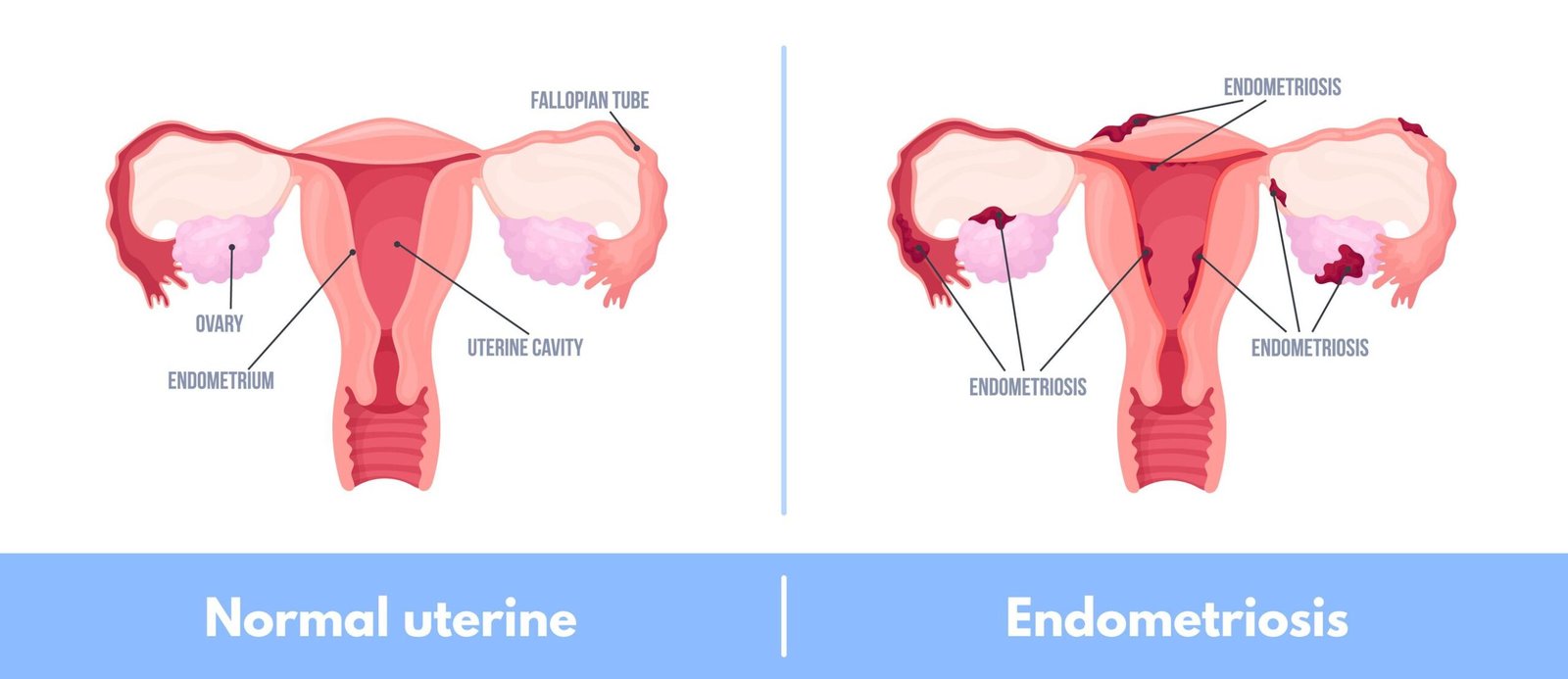What is Endometriosis and normal uterine