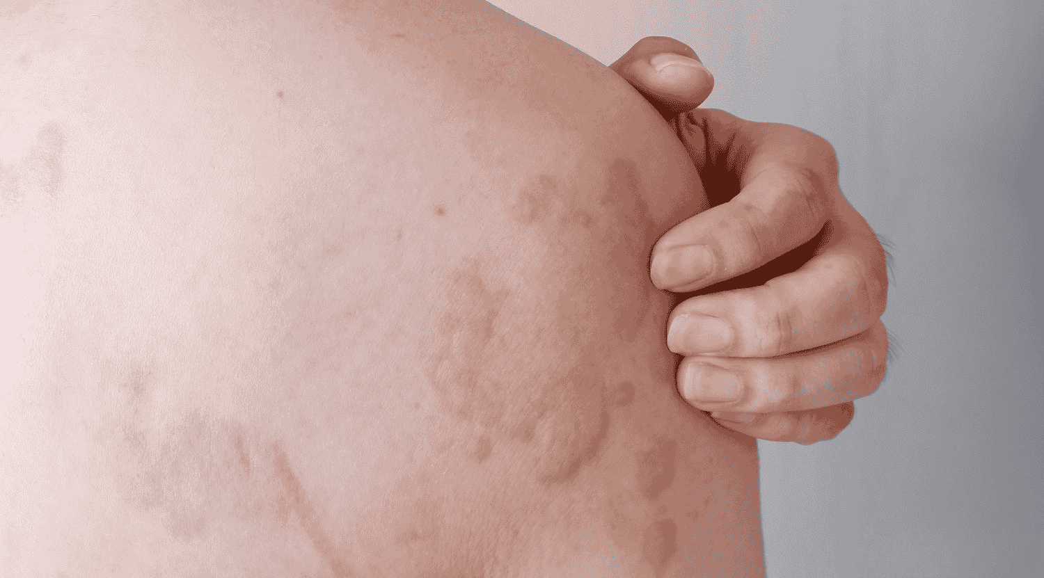 urticaria symptoms