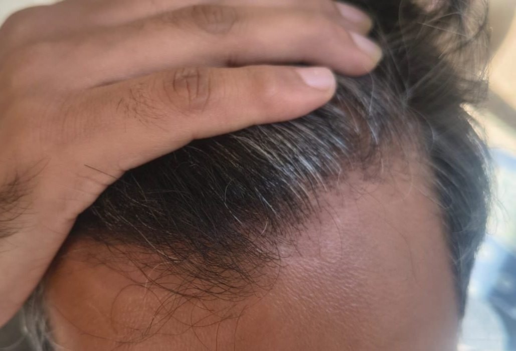 After treatment Scalp Psoriasis case study